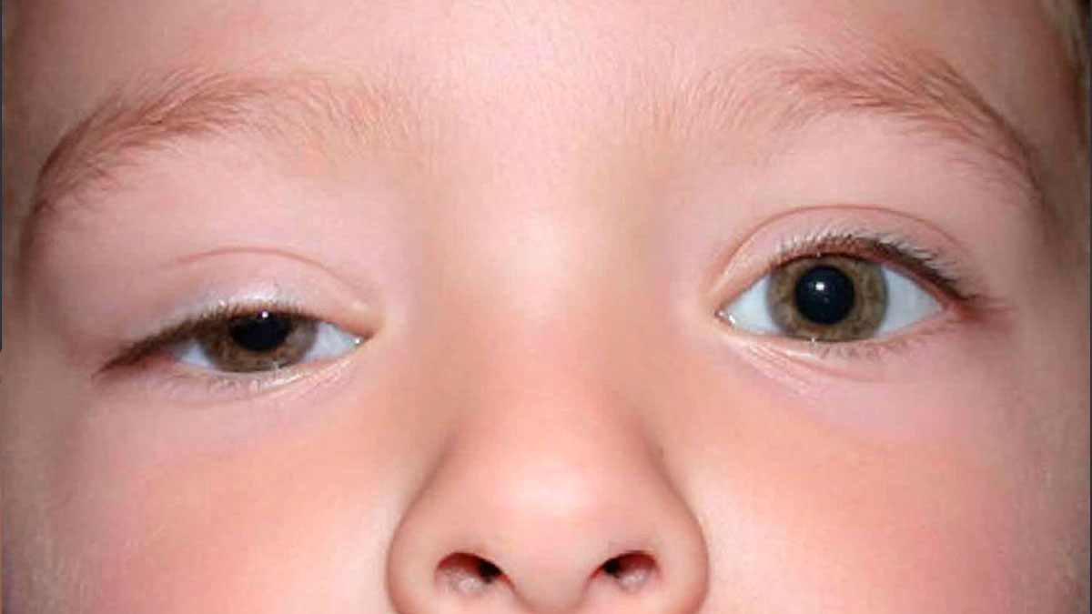  Cirurgia de Ptose Congênita: Restabelecendo a Função e a Estética dos Olhos